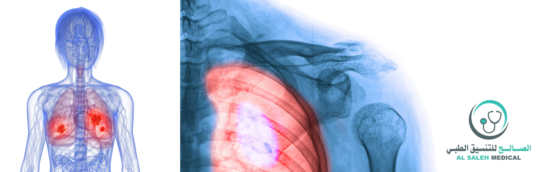 علاج سرطان الرئة في الهند | التكلفة والمستشفيات الرائدة